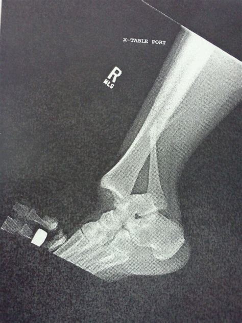 Dislocated Ankle With Broken Fibula Broken Bone Broken Fibula
