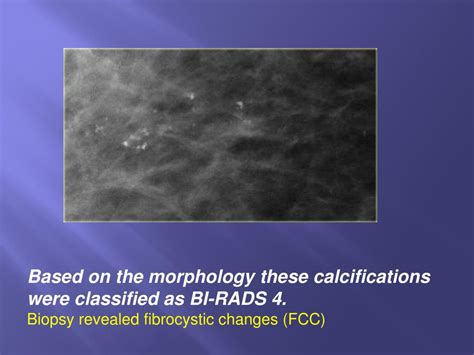 Ppt Breast Calcifications Differential Diagnosis And Birads
