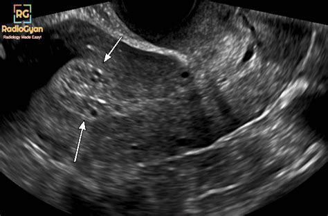 36 Uterine Cancer Ultrasound Endometrial Hyperplasia