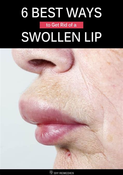 6 Best Ways To Get Rid Of A Swollen Lip