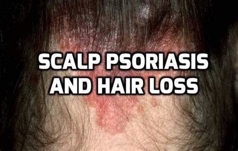 Hair Loss Due To Scalp Psoriasis Is Not Permanent