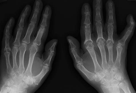 Psoriatic Arthritis Hands Radiology At St Vincents University