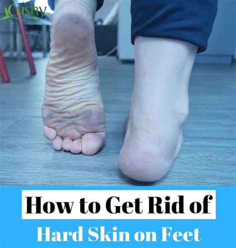 How To Get Rid Of Dead Skin On Feet Step By Step Guide Dead Skin On Feet Dead Skin Hard