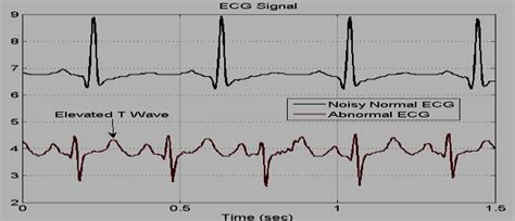 A Normal Vs Abnormal Ecg Download Scientific Diagram