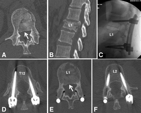 Clinical Example Of Spine Damage Control For An Unstable L1 Complete