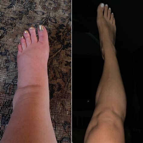 Jessica Simpson Posts Pic Of Postpartum Ankles After Swollen Pregnancy