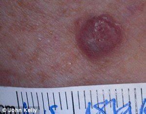 Long, convoluted sentences make your readers work extra hard to follow what you're saying. How Common Is a Flesh Colored Melanoma? — Scary Symptoms