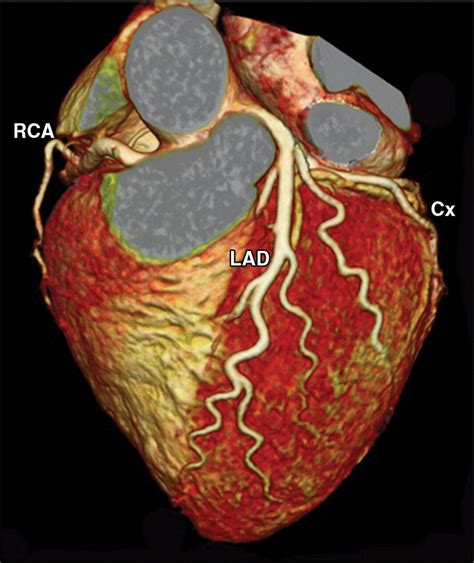 Coronary Artery Ct Scan