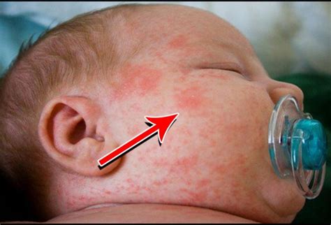 A rash may cause spots that are bumpy, scaly, flaky, or filled with pus. Milk Allergy In Babies: Symptoms And Treatment - Suis Enceinte