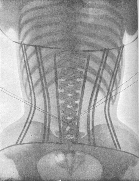 X Rays Von Frauen Die Sich In Korsetts Quetschen Röntgenstrahlen Korsett Frau