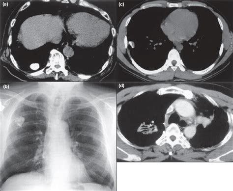 Computed Tomograms And X Rays Of A Solitary Pulmonary Nodule A A