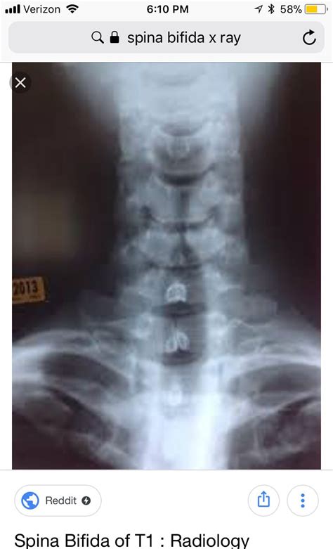 Spina Bifida X Ray Radiology Xray Tech
