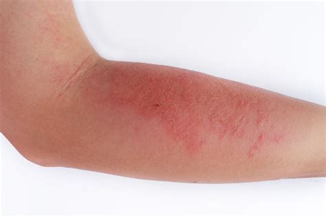 Dermatita Atopica Eczema Atopica