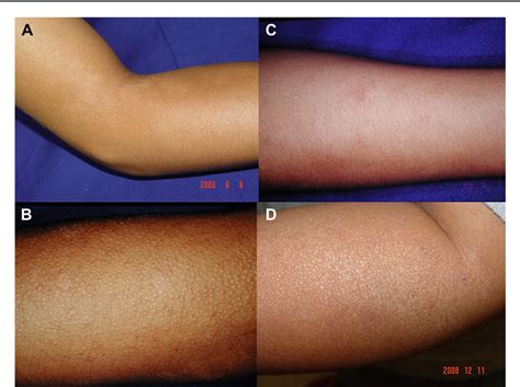 Figure 1 From Clinicopathologic Study Of Solar Dermatitis A Pinpoint
