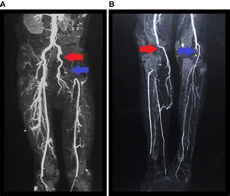Lower Extremity Angiography