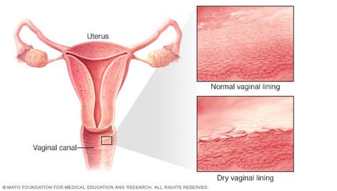 Vaginal Atrophy Symptoms And Causes Mayo Clinic