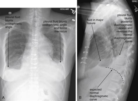 Imaging The Chest The Chest Radiograph Radiology Key
