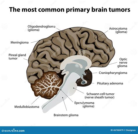 The Most Common Primary Brain Tumors Stock Vector Image 46768479