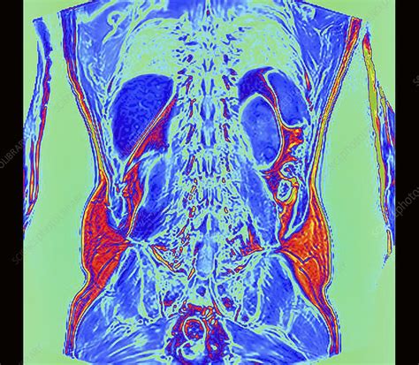 Abdominal Mri Scan Stock Image C0459141 Science Photo Library