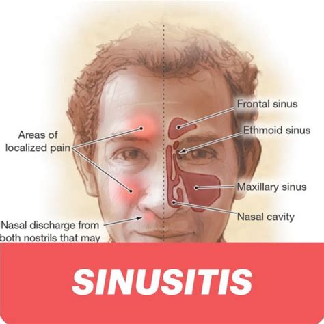 sinusitis types causes symptoms complications sinus headache sinusitis chronic sinusitis