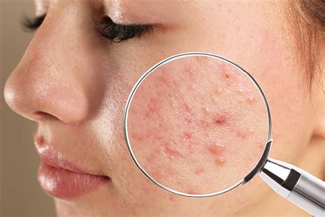 The Best Ways To Get Rid Of Pitted Acne Scars Be Beautiful India