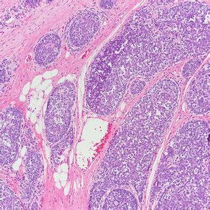 Basal Cell Adenocarcinoma With Invasion Of Cells Into The Surrounding
