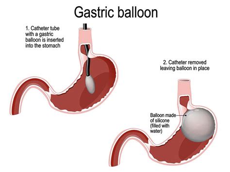 Gastric Balloon Medlife Group