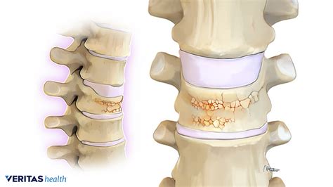 Osteoporosis The Primary Cause Of Collapsed Vertebrae