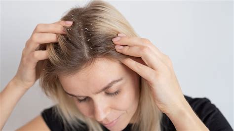 Redness On Scalp Expert Lists Signs Of Scalp Eczema And Its Types