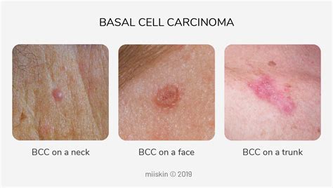 Basal Cell Carcinoma Early Stages Chest