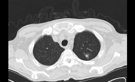 Suspicion Of Lung Cancer With Nodal Metastases In An Immunocompromised