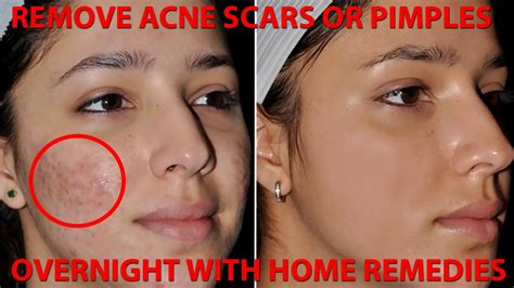 How To Get Rid Of Acne Scars Or Pimples Naturally And Fast With Home