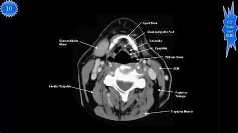 Vascular Anatomy Of The Neck