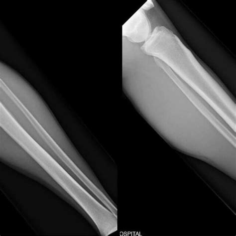 Orthogonal Radiographic Views Of The Patients Left Tibia And Fibula No