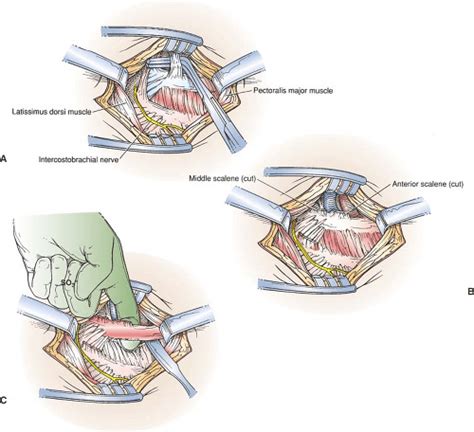 First Rib Resection For Thoracic Outlet Syndrome Basicmedical Key