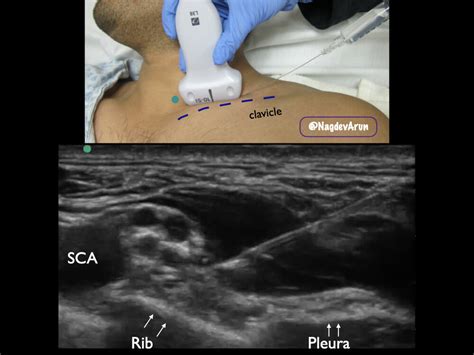 Supraclavicular Brachial Plexus — Highland Em Ultrasound Fueled Pain