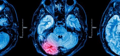 Enfermedades Del Cerebro ¿las Conoces Supercurioso