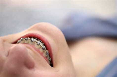 5 Things To Know Before Getting Braces Ismile Dental Centre