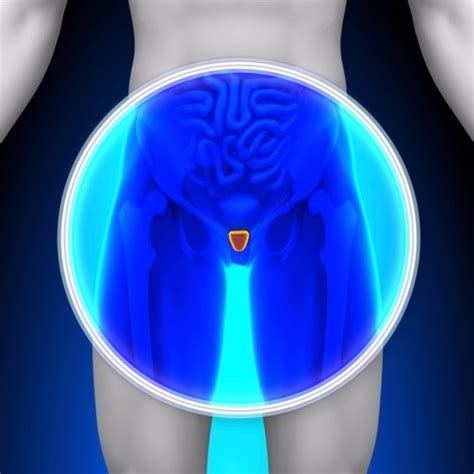 Explains prostate problems including prostatitis and benign prostatic hyperplasia. La detección temprana del cáncer de próstata debe romper ...