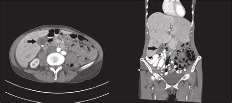Axial And Coronal Images Of A Computed Tomography Showing A Gallbladder
