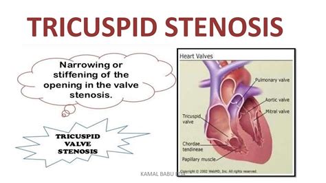Tricuspid Stenosis Youtube