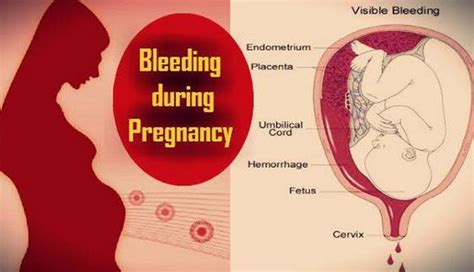 Any Kind Of Bleeding During Pregnancy Needs Attention