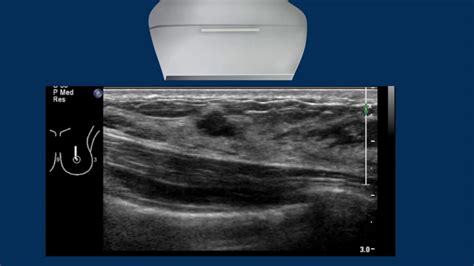 Breast Ultrasound Cancer 3 Youtube