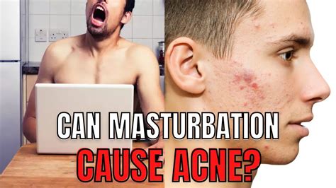 Can Masturbation Cause Acne Pimples Masturbation Myths Part Hindi