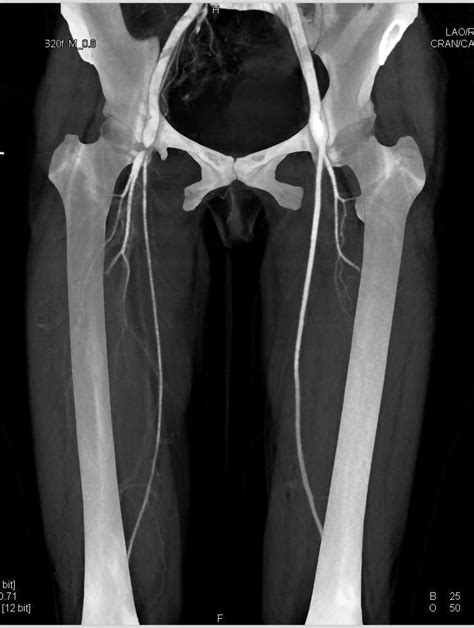 Critical Stenosis Of The Right Superficial Femoral Artery Sfa With