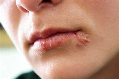 What Is Herpes Labialis Meaning Ideas Of Europedias