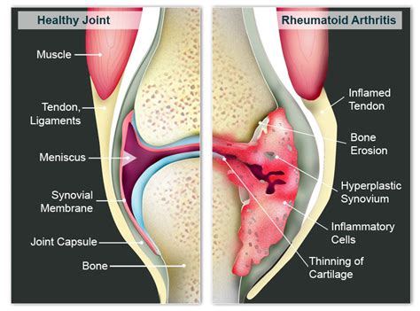 Within the body, joints are the points where bones come together and allow for movement. What is rheumatoid arthritis (RA)? - Arthritis (Rheumatoid ...