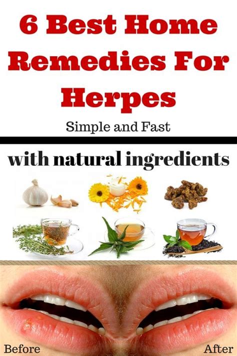 Pin On Remedies For Herpes