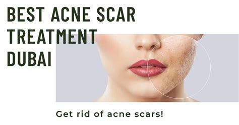 Best Acne Scar Treatment Dubai Laser Treatments