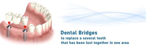 Dental Implants Teeth Implants In Thailand Bangkoks Top Dental